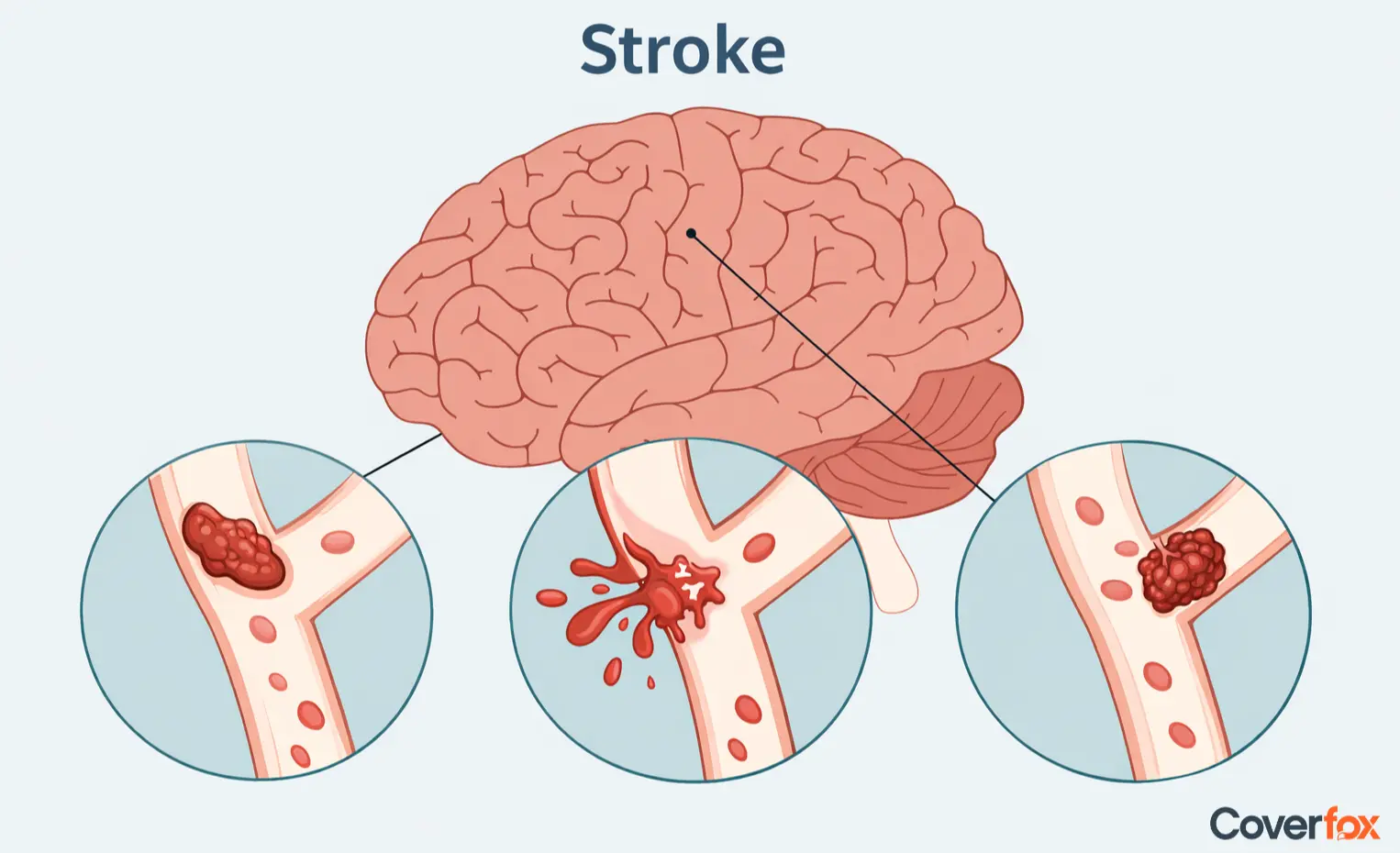 What is a Stroke?